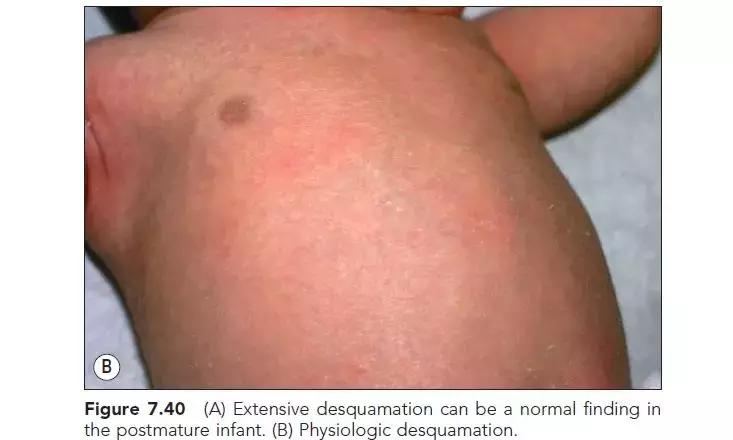 新生儿皮肤问题大全一览表,新生儿常见八大皮肤问题