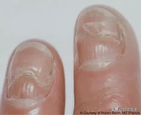 指甲的哪些变化需警惕疾病风险,指甲上有竖条纹是哪些疾病的征兆