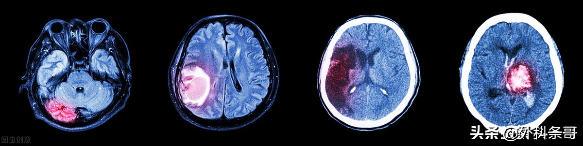 脑出血脑疝开颅手术后遗症,脑出血后遗症偏瘫能手术治疗吗