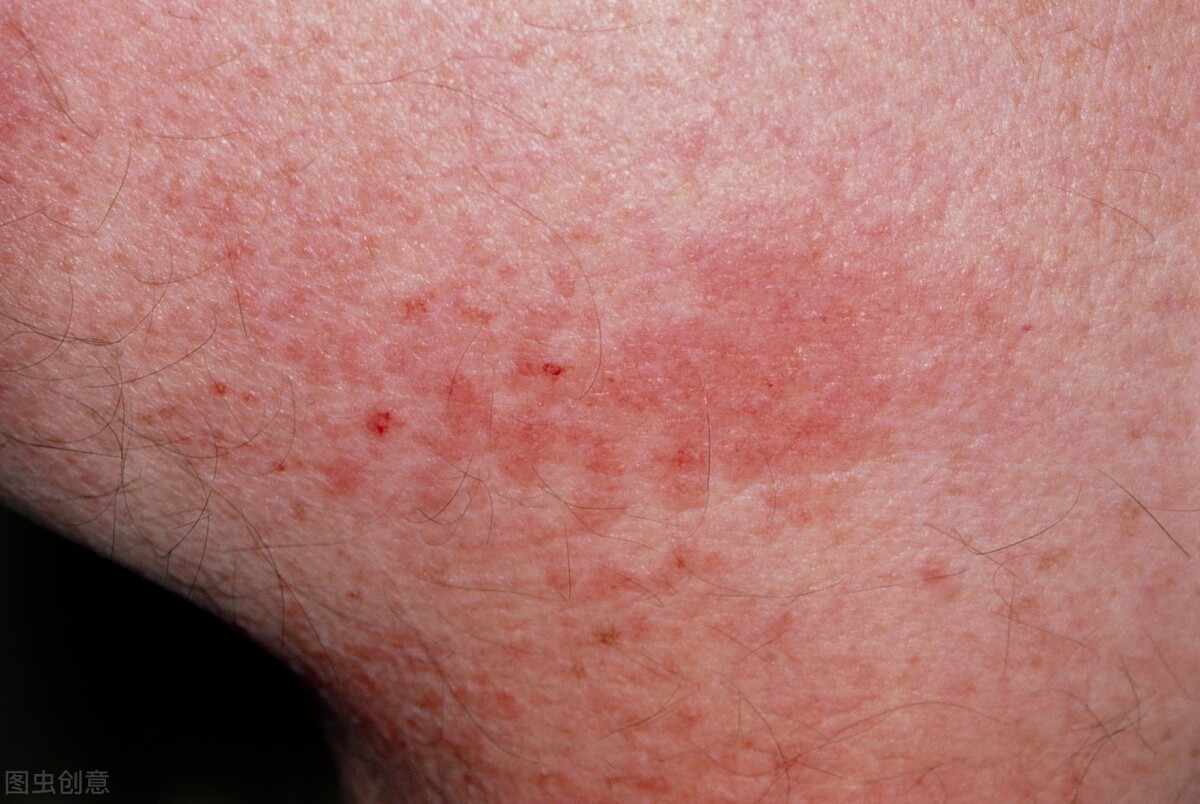 治疗类风湿性关节炎最快的中成药,类风湿关节炎吃什么药增强免疫力