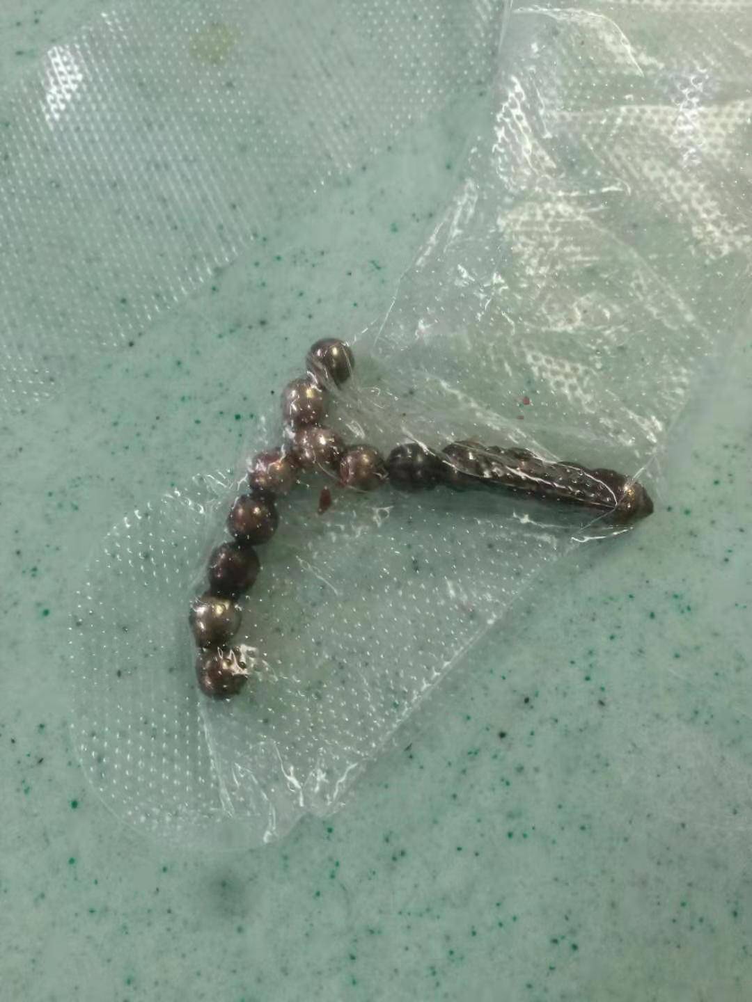 男童误吞11颗磁力珠后来怎么处理,男童误吞11颗磁力珠新闻