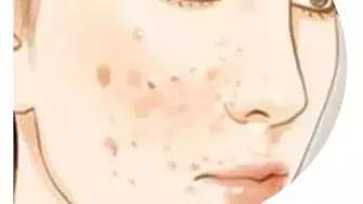 痘印根本治不住怎么办,痘印反反复复消不掉