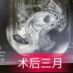 消除子宫肌瘤可用中药治疗吗,消除子宫肌瘤的特效药