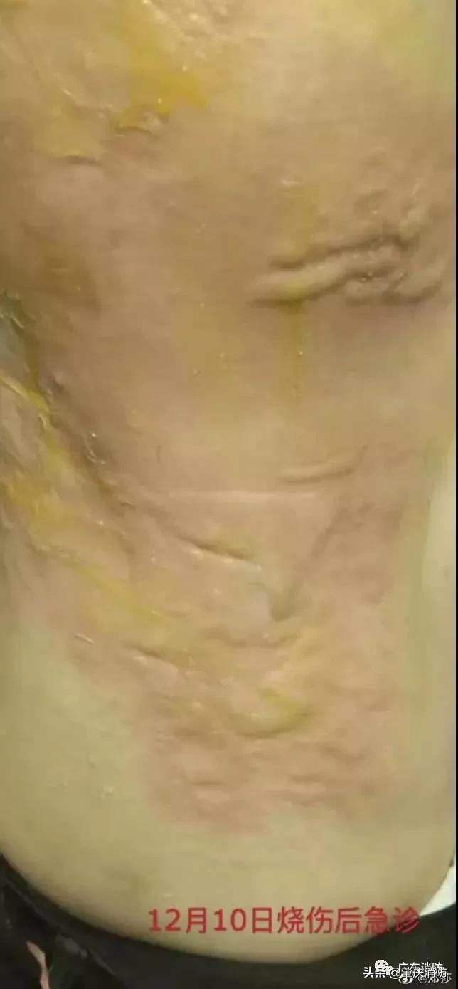 女子拔火罐被烧伤后续,明星拔火罐烧伤事件