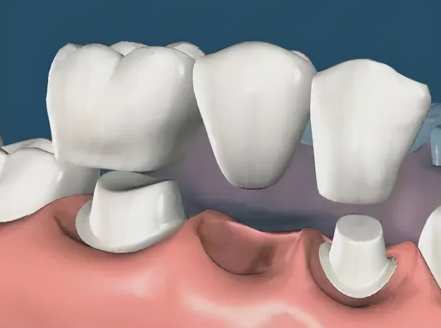 烤瓷牙破冠怎么办,基牙损坏保留烤瓷冠
