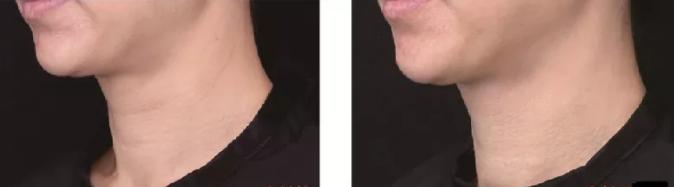 面部抗全面衰强攻略