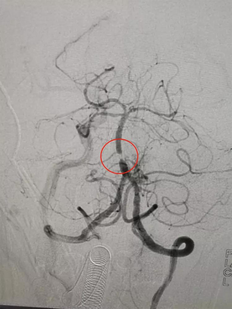 颅内动脉支架成形术，让塌陷的颅内动脉重获新生