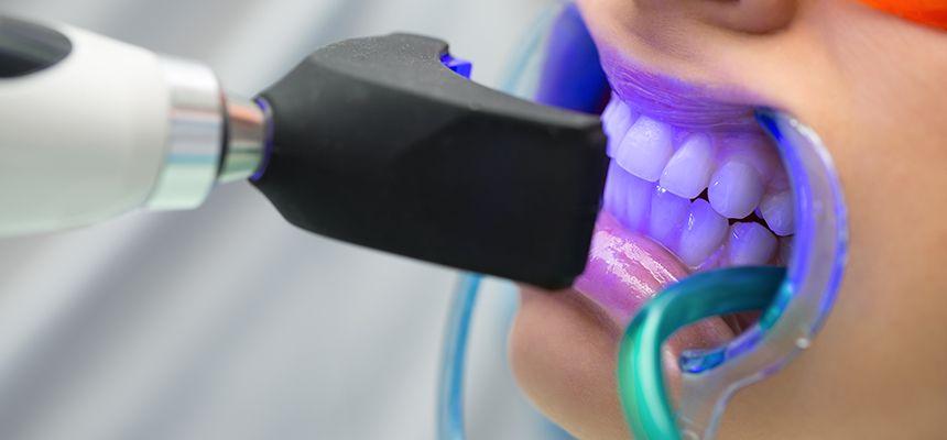 用美白仪美牙视频,用美白仪牙龈会萎缩吗