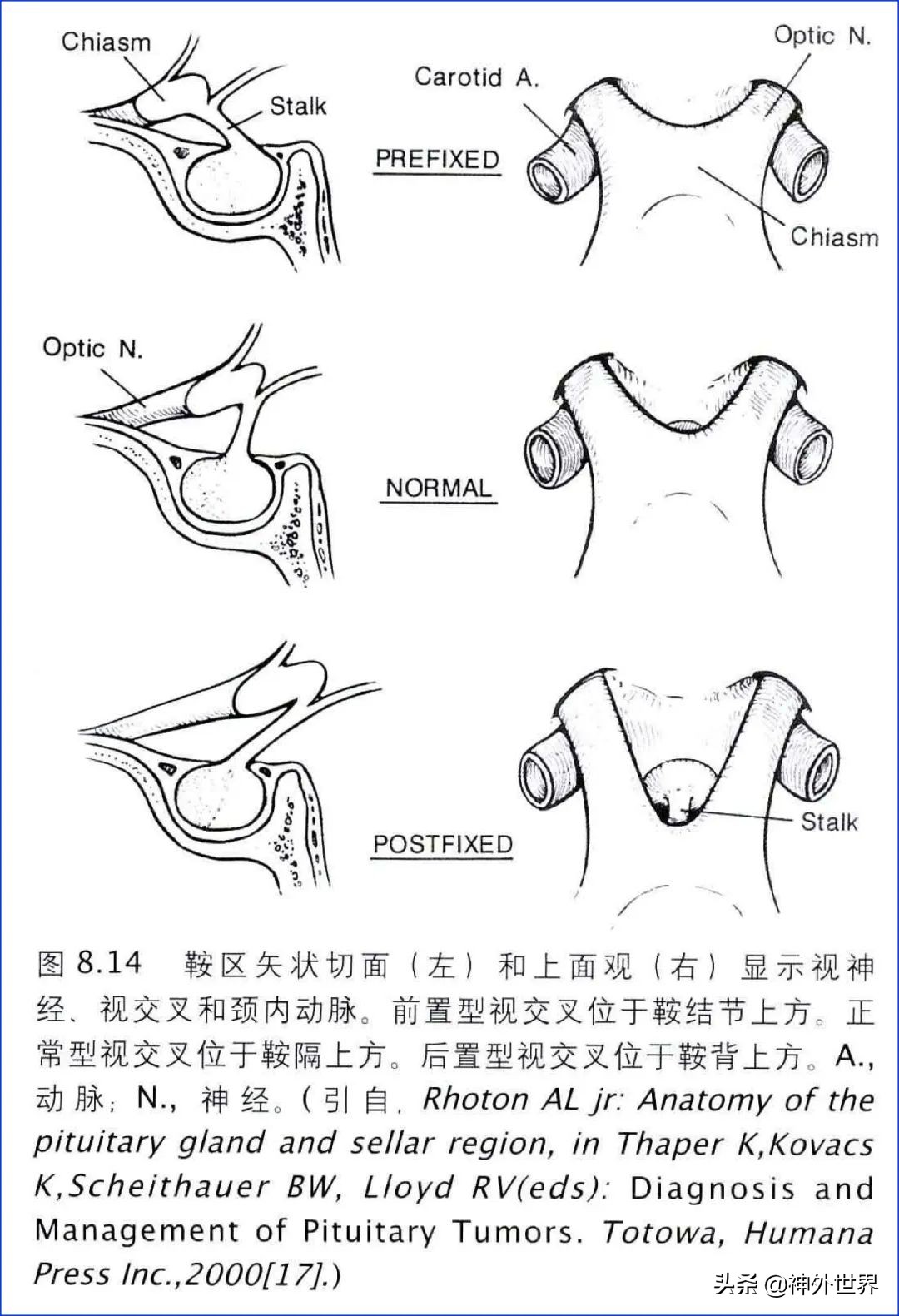 鞍区核磁解剖图,鞍区解剖与手术