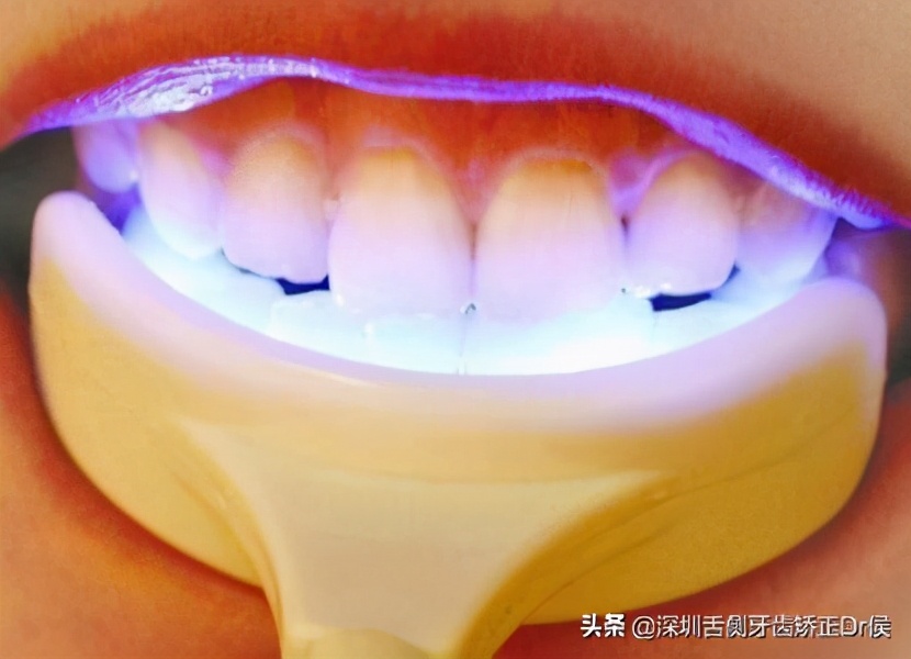 牙齿美白去黄的最快方法,牙齿美白最好的方法用什么牙膏