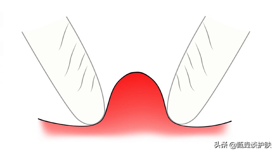 痘痘越挤越大越硬,痘痘黄了要不要挤