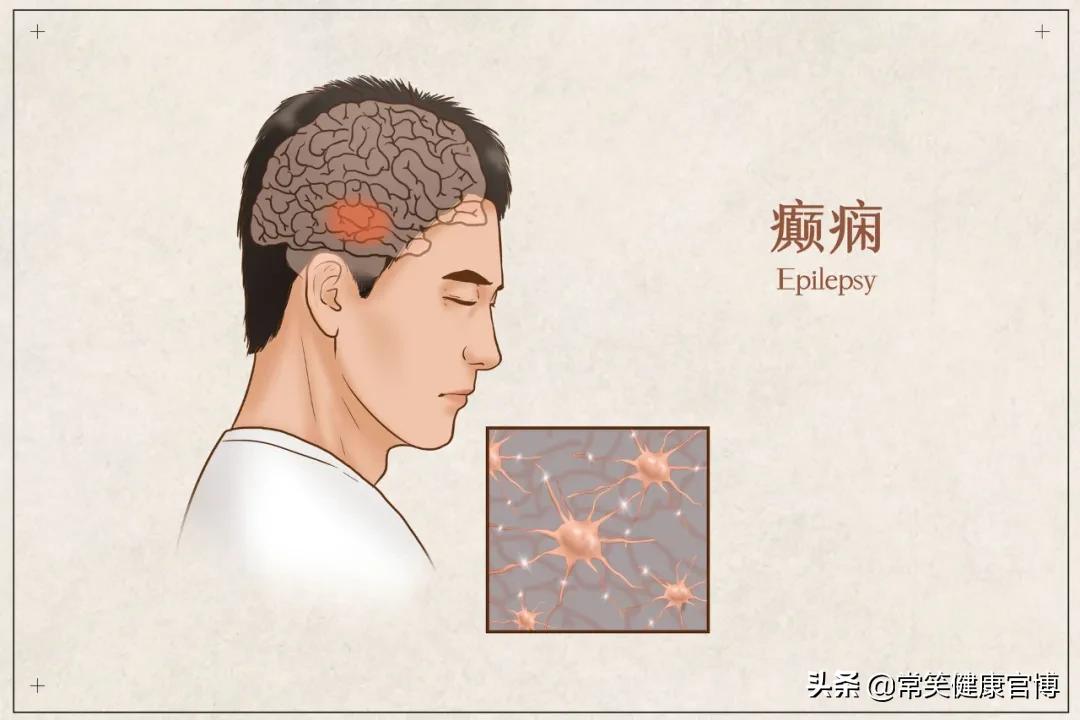 癫痫患者可以怀孕吗,癫痫患者吃药怀孕对胎儿的影响