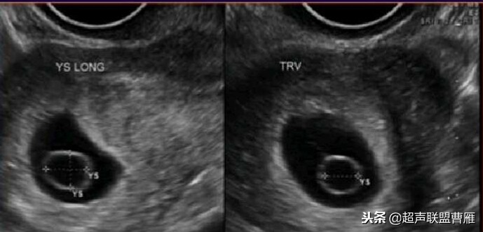 内见卵黄囊,卵黄囊肿瘤