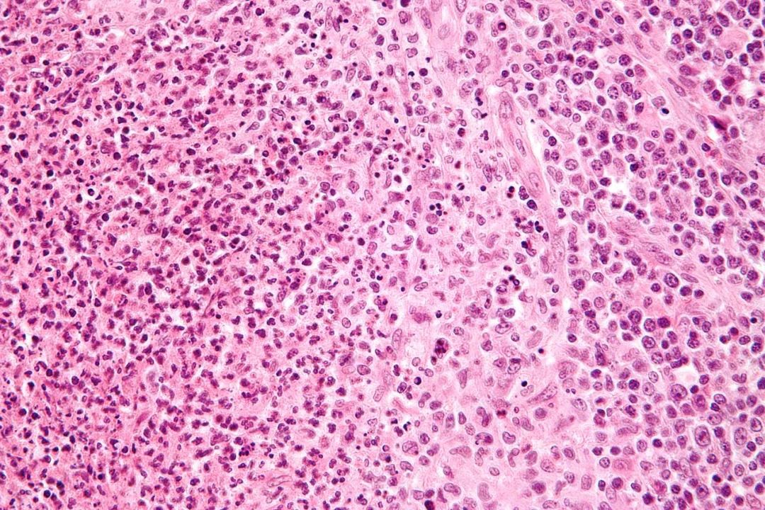 十六岁的男孩精神分裂症的前兆,14岁精神分裂症妄想症有哪些表现