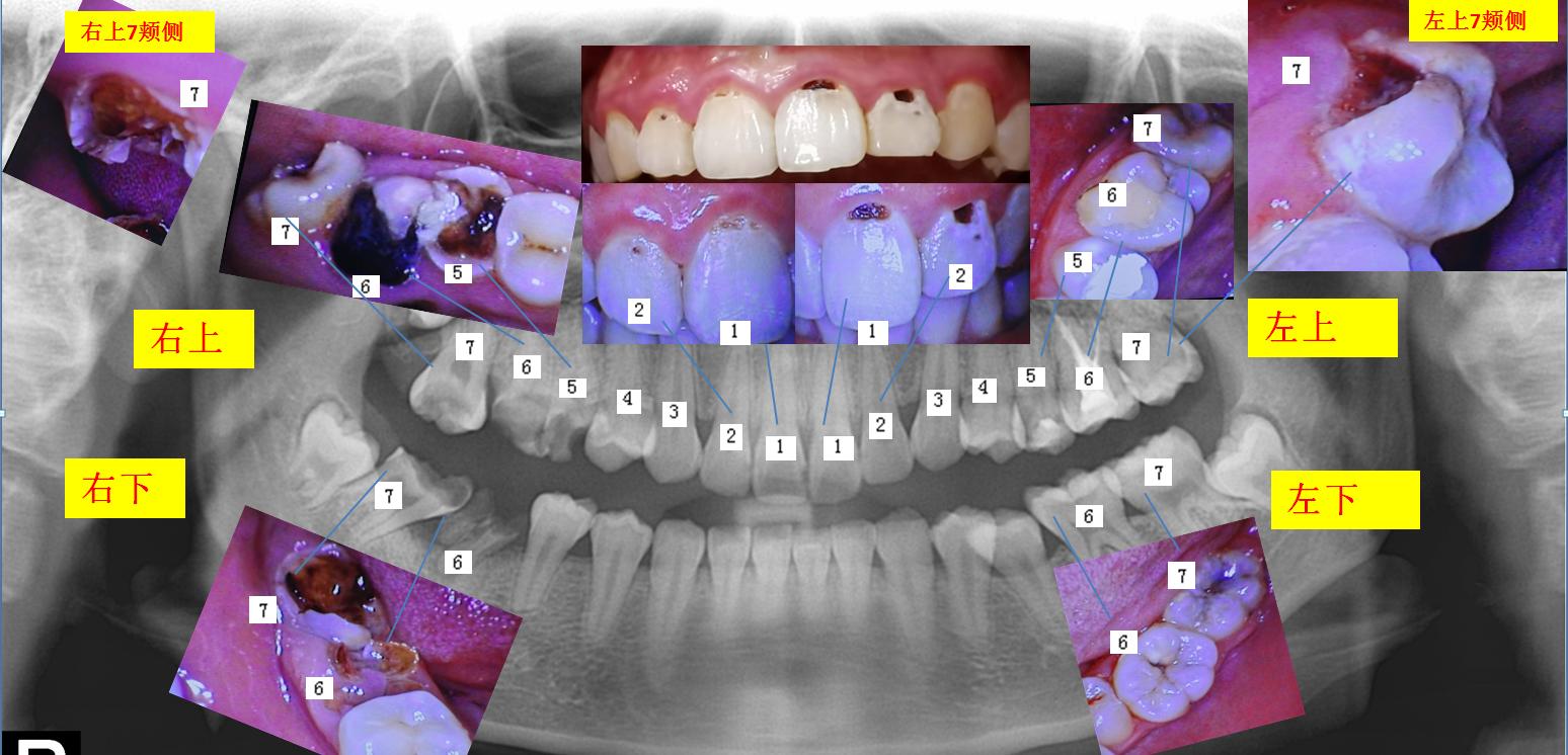 后磨牙可以拔掉吗,后磨牙可以装活动义齿吗