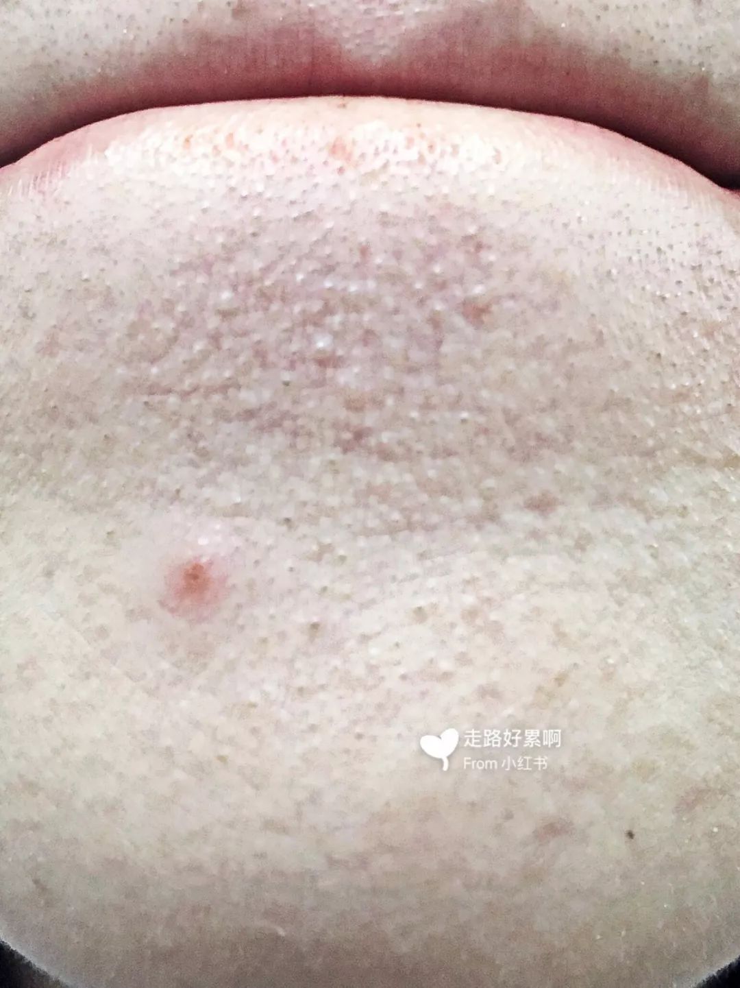 脸部黑头粉刺有必要去美容院挤吗,粉刺黑头应不应该挤掉