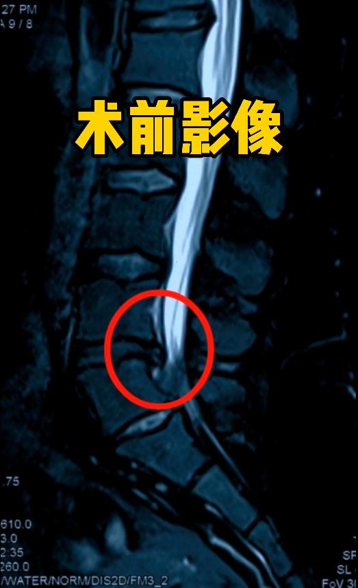 宝妈腰间盘突出是什么引起的,宝妈生过宝宝后腰疼怎么办