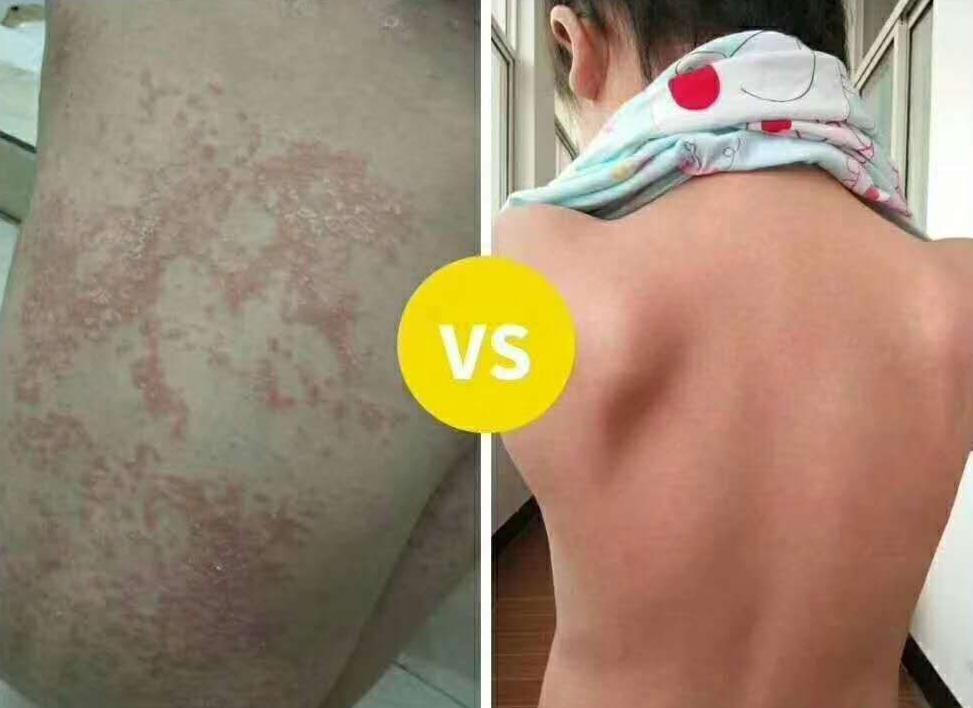 湿疹5年,7年湿疹