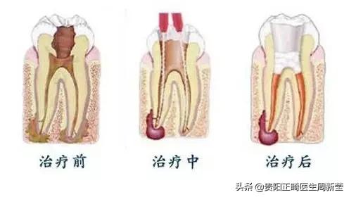 牙疼淋巴肿大是什么原因引起的,牙疼白天不疼晚上疼是什么原因
