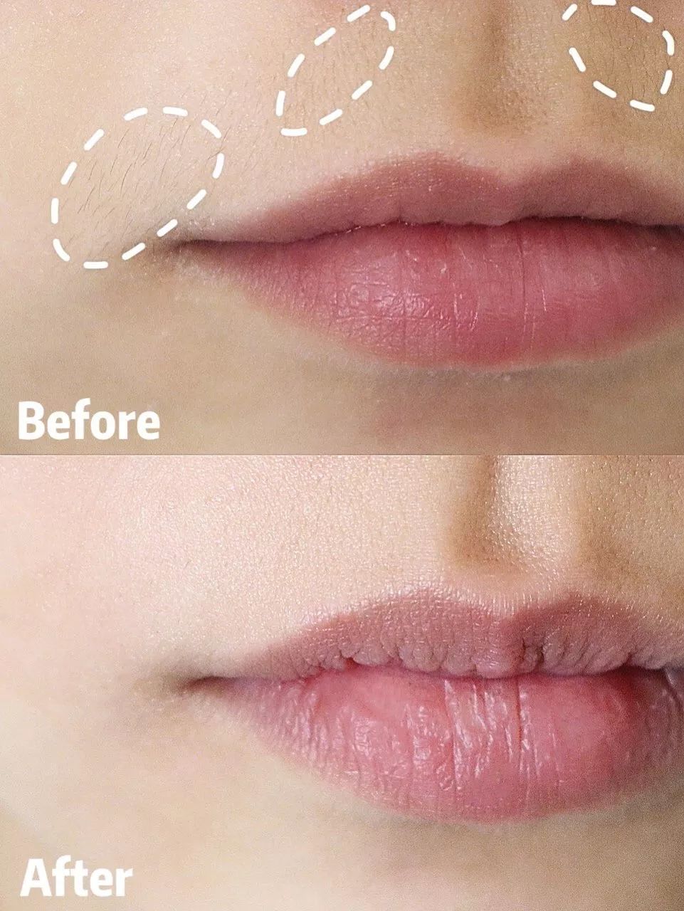 世界公认脱毛最有效的方法,目前最好的脱毛技术