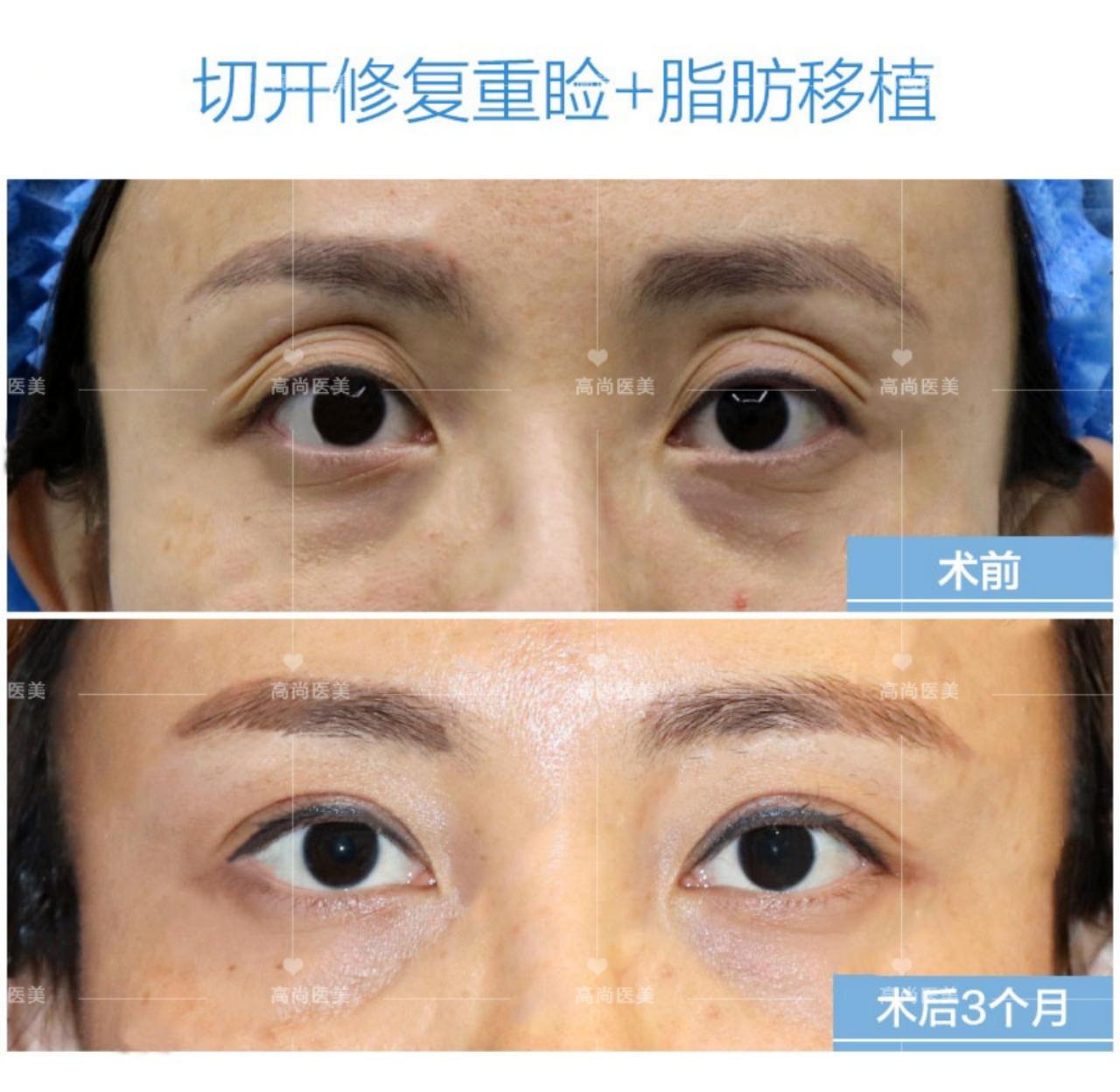 余文林整容后需要住院多久,余文林失败案例