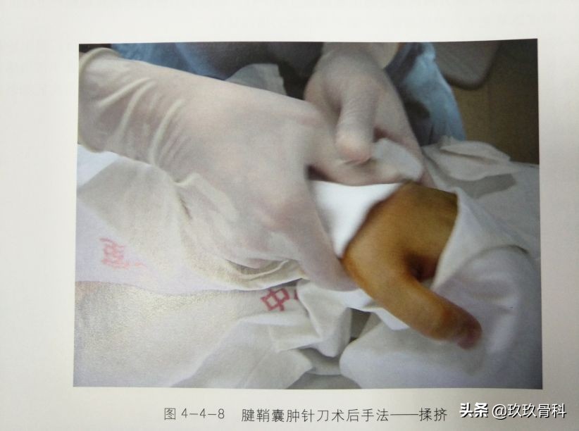 腱鞘囊肿针刺技巧视频,手指腱鞘囊肿正确挤压方法视频