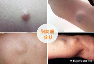 全身皮下能摸到小疙瘩,身上皮下摸到小疙瘩