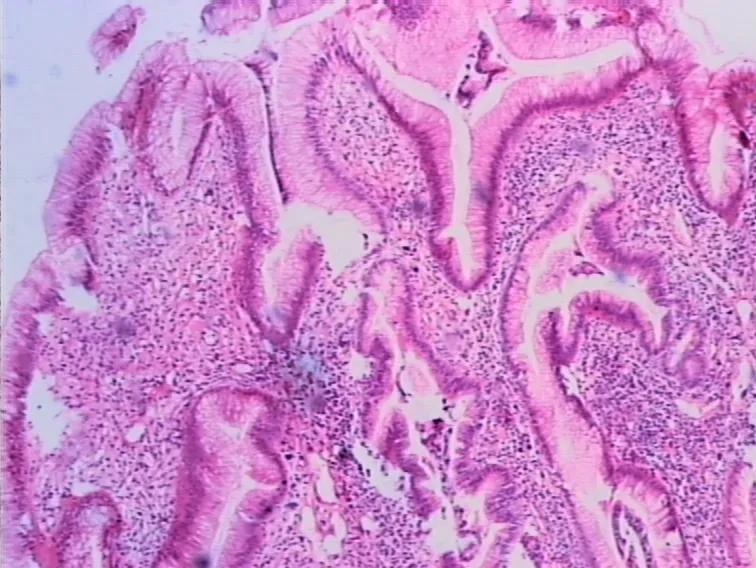 胃息肉一定能癌变吗,胃息肉会癌变吗