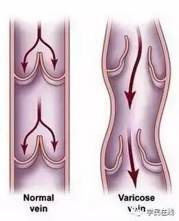 挤火疖子脓包有多痛,挤火疖子会往血管里爆吗
