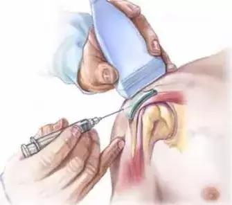 胳膊疼抬不起来理疗手法,胳膊疼的抬不起来怎样锻炼