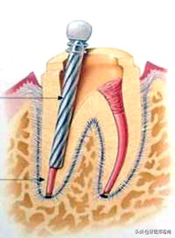 根管治疗一定要做二次吗,根管治疗能中途换医院吗