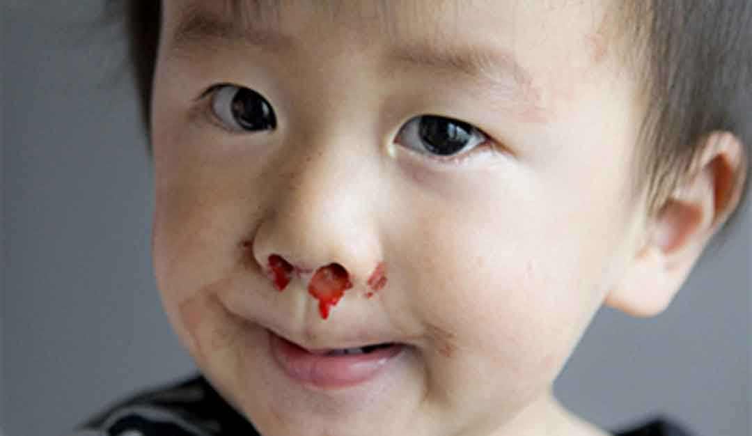 四岁男童夜里鼻子流血都干了,四岁男童左边鼻子出血