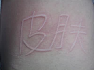 麻疹是由荨麻疹病毒导致的吗,麻疹是皮肤病吗