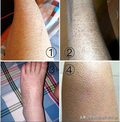 为什么气候湿润的南方也有很多鱼鳞病朋友？鱼鳞皮肤可以去南方吗