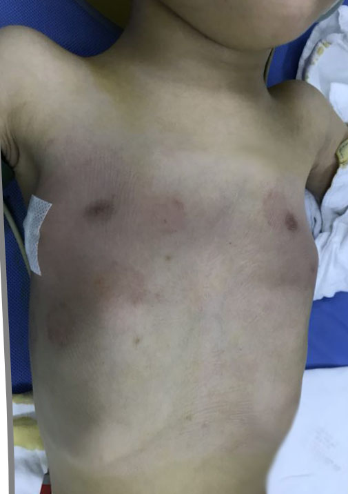 今天的鸡胸Wenlin手术：4岁