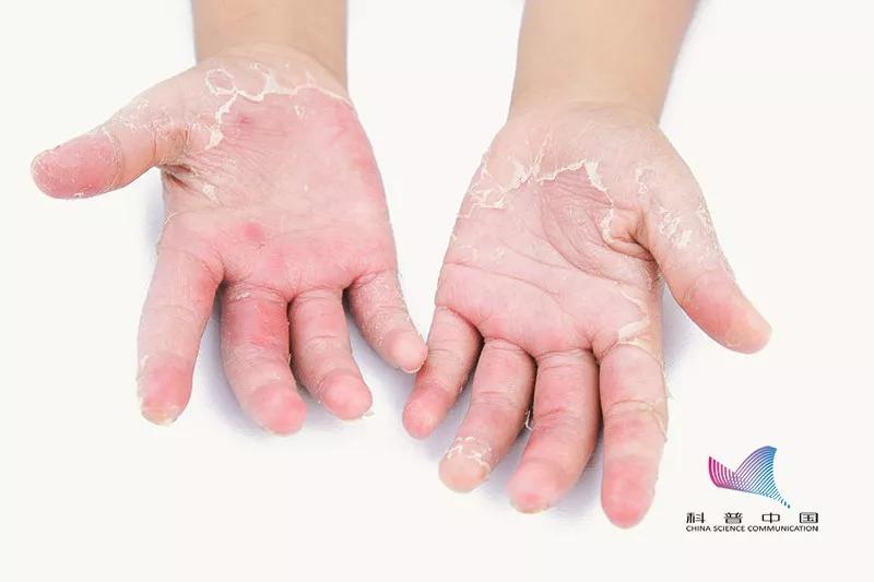 夏天手指上起小水泡很痒怎么回事,为什么一到夏天手上就长水泡很痒