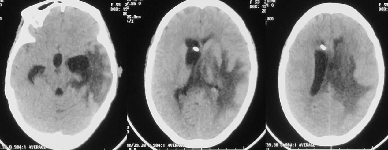 脑脓肿合并脑膜炎需要手术吗,脑脓肿进入左侧脑室严重吗