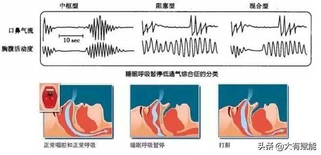 睡眠呼吸暂停监测全过程视频,深度解析呼吸暂停