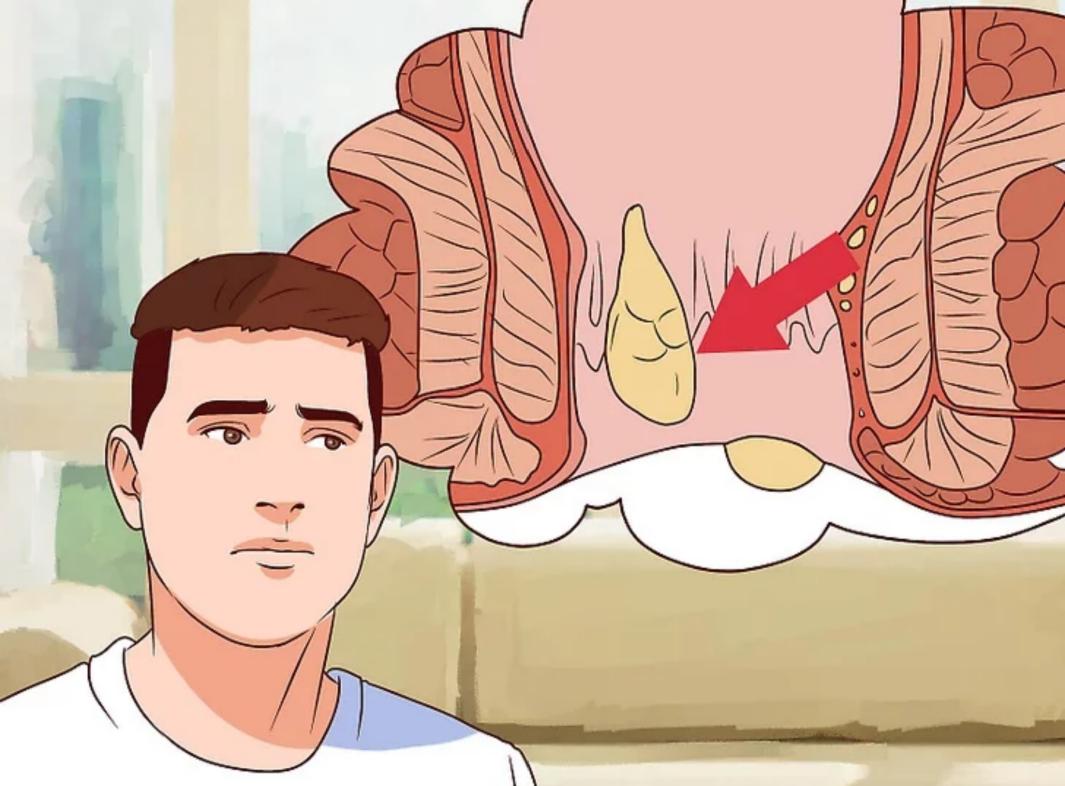 怎样治疗痔疮的最有效方法,简单高效治疗痔疮的方法