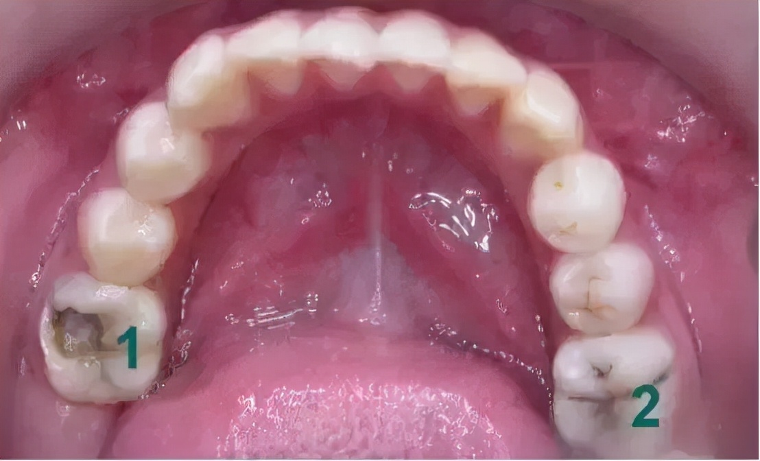 6-12岁换牙怎么换一口好牙,7岁换牙期注意事项怎么才整齐