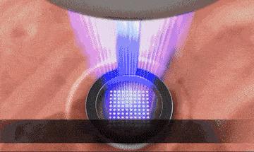 带你了解激光美容走出10个误区,激光美容的12个误区一定要记清