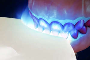 牙齿发黄如何变白有什么方法,牙齿发黄怎么办教你一招变白