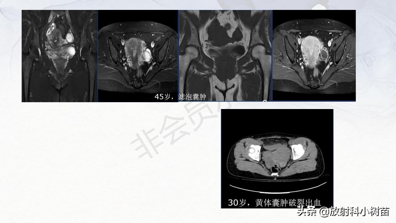 女性盆腔mri解剖图谱,泌尿生殖系统x线解剖
