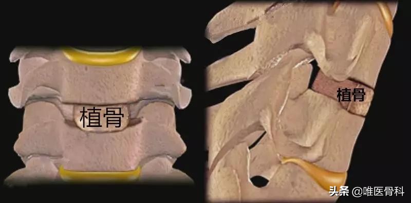 颈椎病做手术哪种方式最好,开放手术和微创手术的区别