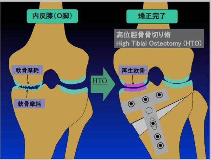 老年人骨性关节炎膝盖疼怎样锻炼,老年人膝关节骨关节炎首选检查