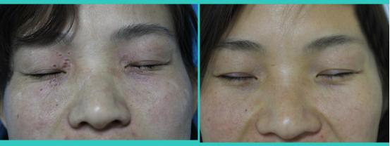 眼睛下面长了汗管瘤用什么药膏,女人眼睛周围长小疙瘩