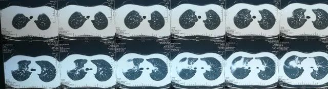 如何在CAP初始治疗后72h内进行病情评价?其成功关键有哪些?