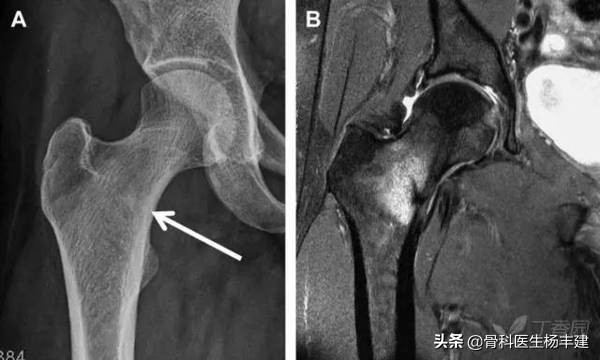 老年人常见的髋部损伤有哪些,跑步的常见损伤之髋关节