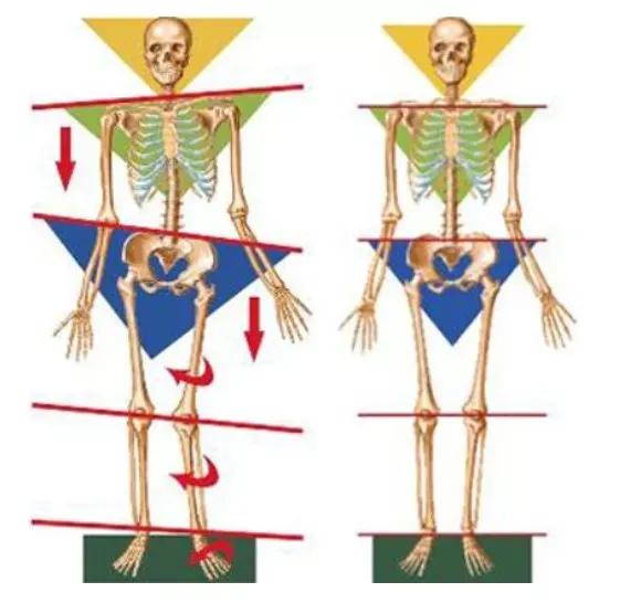 如何判断扁平足是先天还是后天,扁平足简单自测