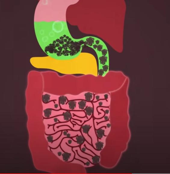 误食口香糖粘在喉咙,误食口香糖卡在肠胃里怎么办